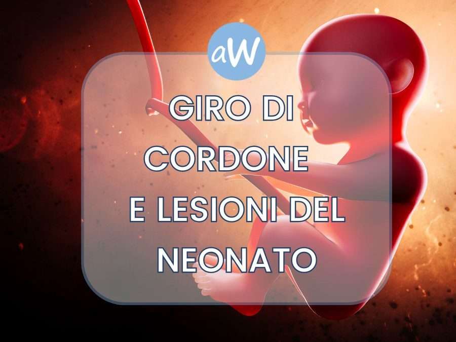 Giro di cordone del neonato: risarcimento per errori medici