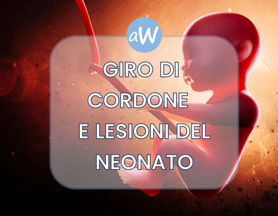 Giro di cordone del neonato: risarcimento per errori medici