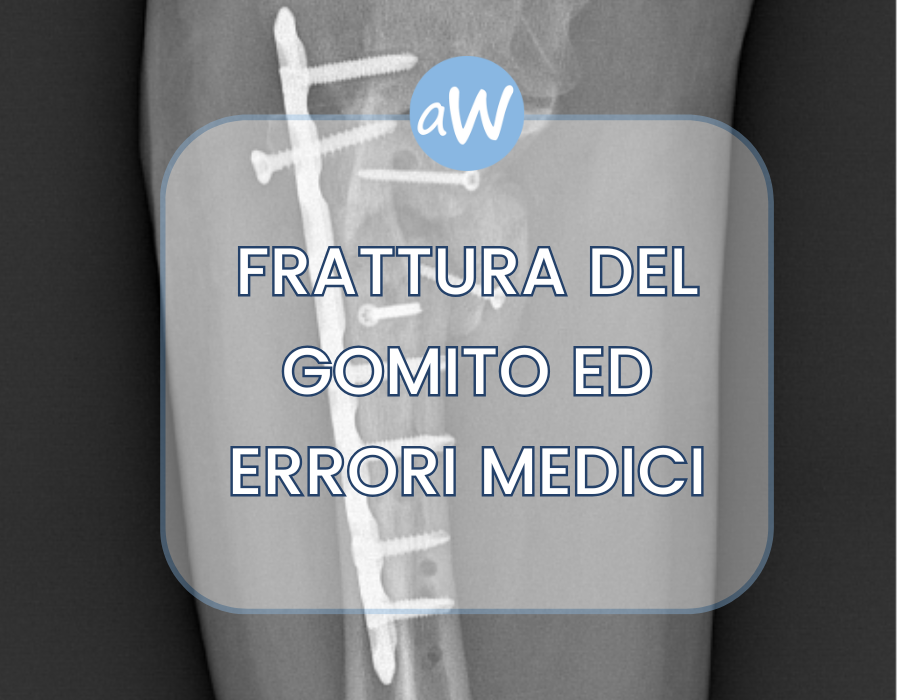 Fratture del Gomito: Errori Medici e Risarcimento