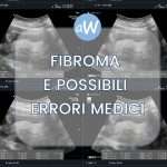 Fibroma a Utero o Seno e casi di Malasanità: come ottenere il Risarcimento