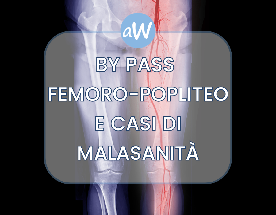 Revisione del By Pass Femoro-Popliteo e Casi di Malasanità